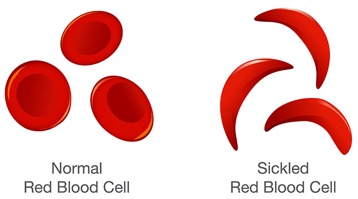 National Sickle Cell Awareness Month- do you know your status?